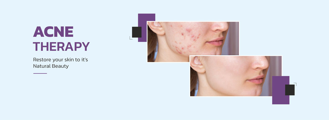 Acne Therapy